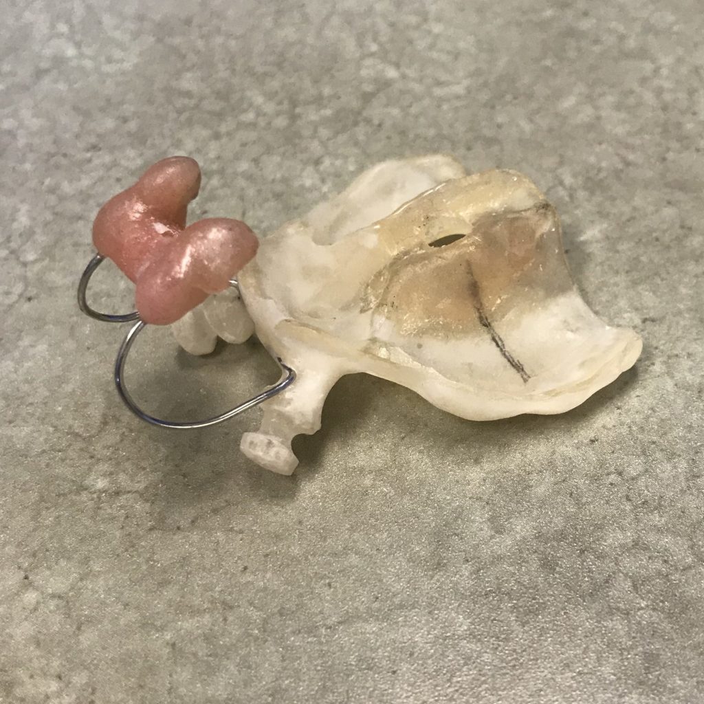 We love our cleft palate babies! Advance Orthodontics